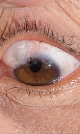 Cirurgia de trabeculectomia Santa Terezinha em São Gonçalo